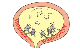 膀胱炎