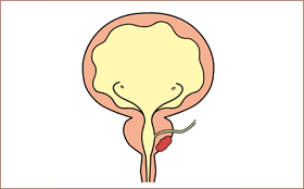 前立腺がん１