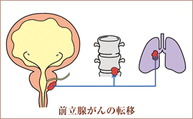 前立腺がん２